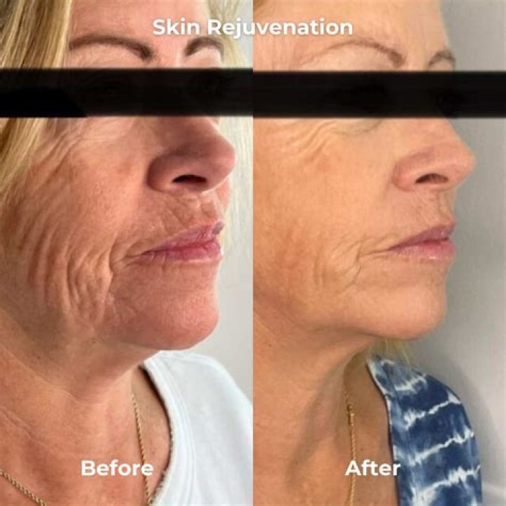 Skin tightening treatments at Visthetic Surgery Institute & MedSpa in Beverly Hills holistically falling in the range of $3,000.00 to $15,000.00.